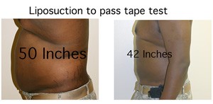 Liposuction to pass tape test
